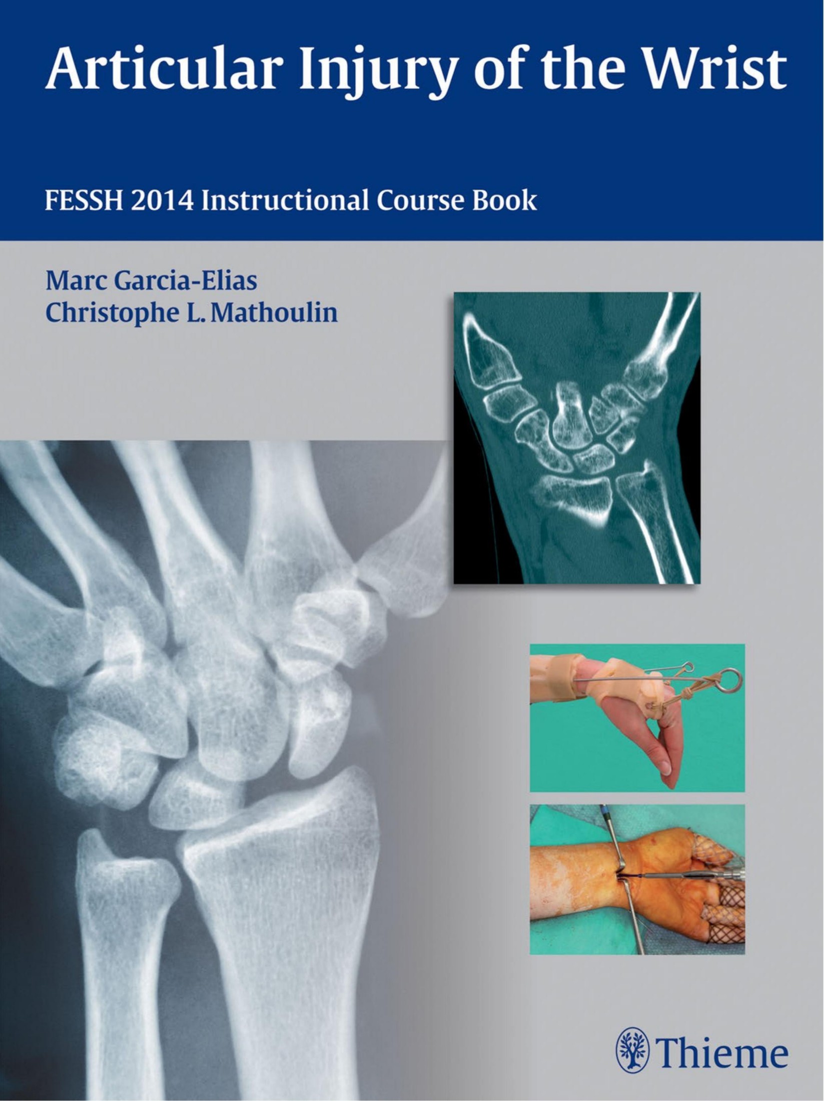 Articular Injury of the Wrist-FESSH 2014 Instructional Course Book, 1E (2014) - Wei Zhi.jpg