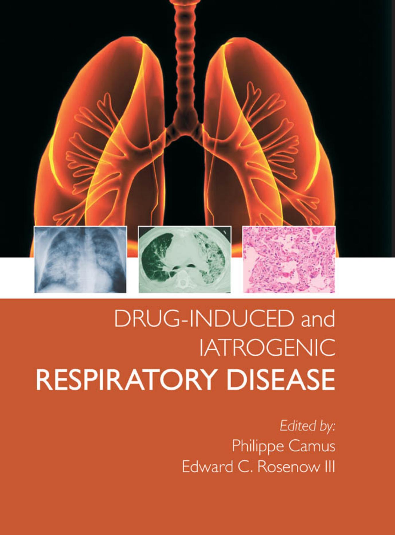 Drug-induced and Iatrogenic Respiratory Disease - Camus, Philippe.,Rosenow, Edward C_.jpg
