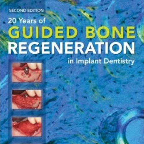 20 Years of Guided Bone Regeneration in Implant Denistry - Wei Zhi