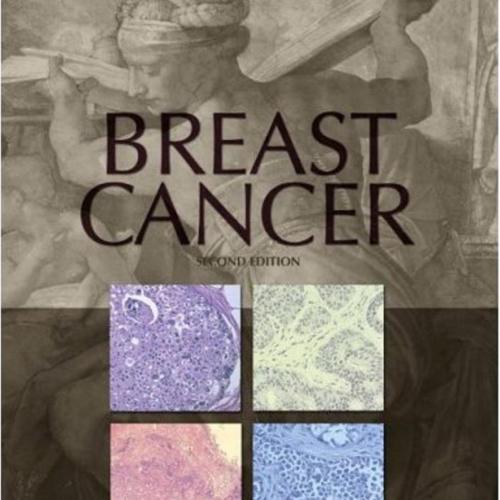 Breast Cancer,2nd Edition