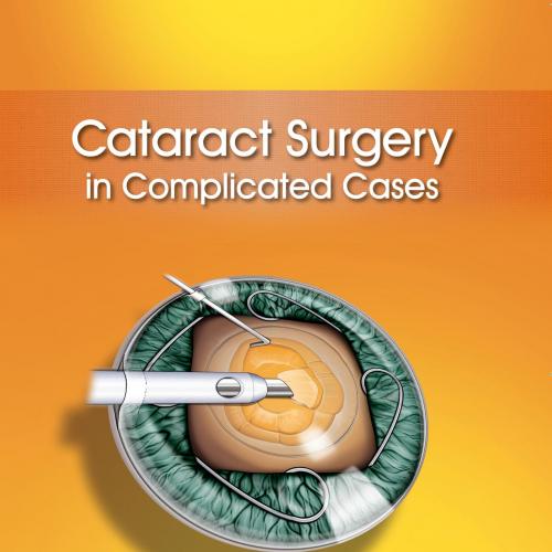 Cataract Surgery In Complicated Cases