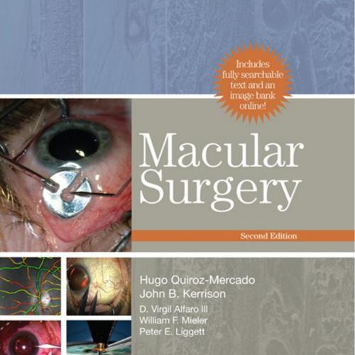 Macular Surgery, 2nd Edition