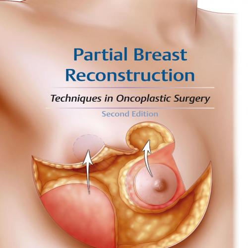 Partial Breast Reconstruction 2nd Edition