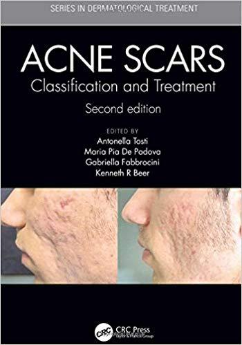Acne Scars Classification and Treatment