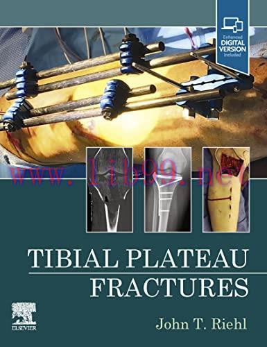 [PDF]Tibial Plateau Fractures