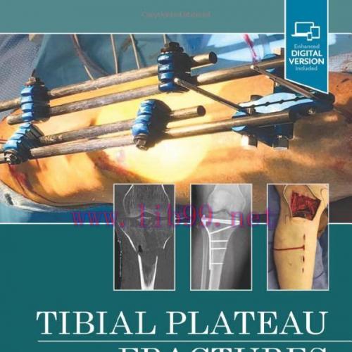 [AME]Tibial Plateau Fractures (Original PDF)