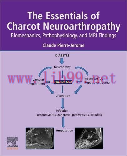 The Essentials of Charcot Neuroarthropathy: Biomechanics, Pathophysiology, and MRI Findings (Original PDF)