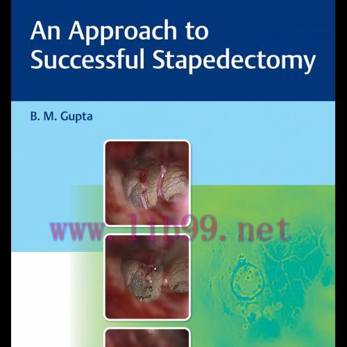 [AME]An Approach to Successful Stapedectomy (Original PDF)