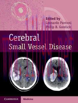 [AME]Cerebral Small Vessel Disease
