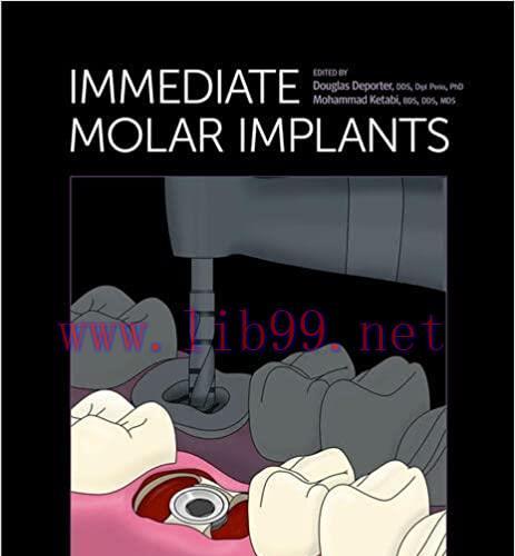 [PDF]Immediate Molar Implants [Douglas Deporter]