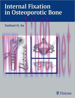 [AME]Internal Fixation in Osteoporotic Bone 