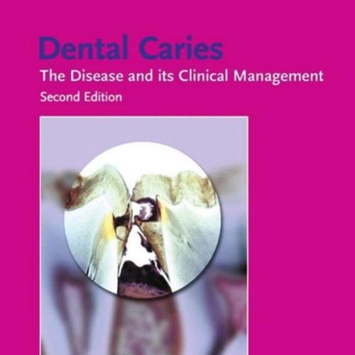 Dental Caries The Disease and Its Clinical Management,2e