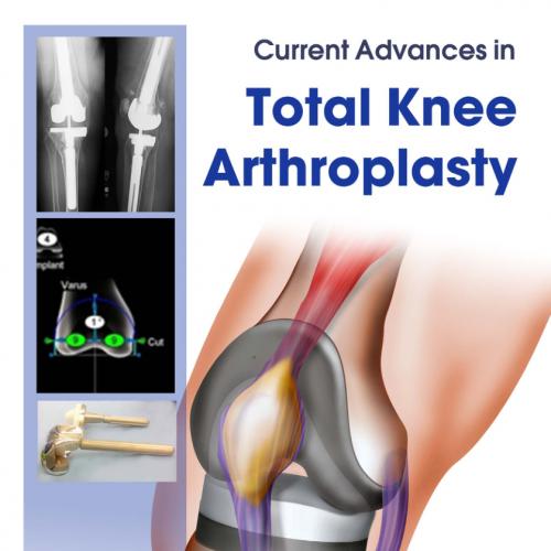 Current Advances in Total Knee Arthroplasty